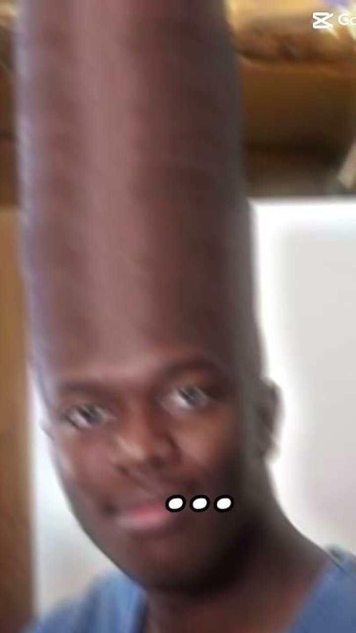 Biggest Foreheads In The World